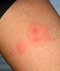 agyi_poloska_csipes_enyhites_thumb