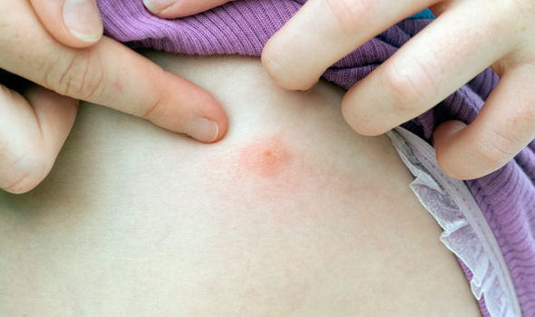 Vörös foltok, hámlás a kézfejen - Bőrbetegségek